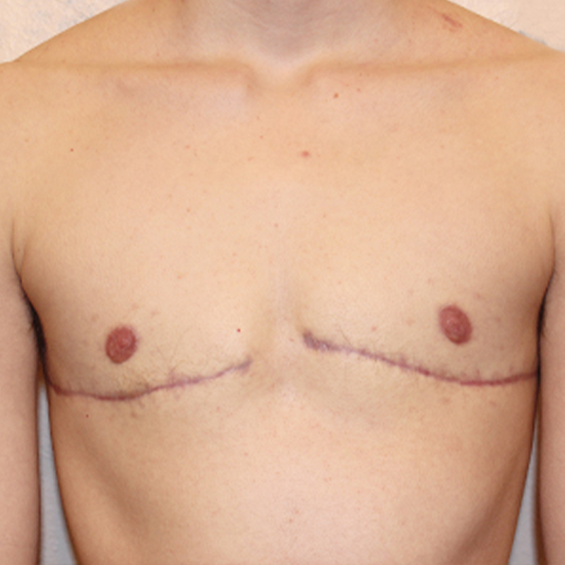 Female To Male Top Surgery 93