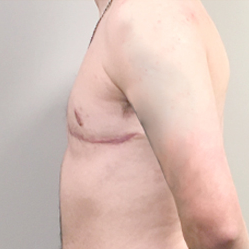 Female To Male Top Surgery 05