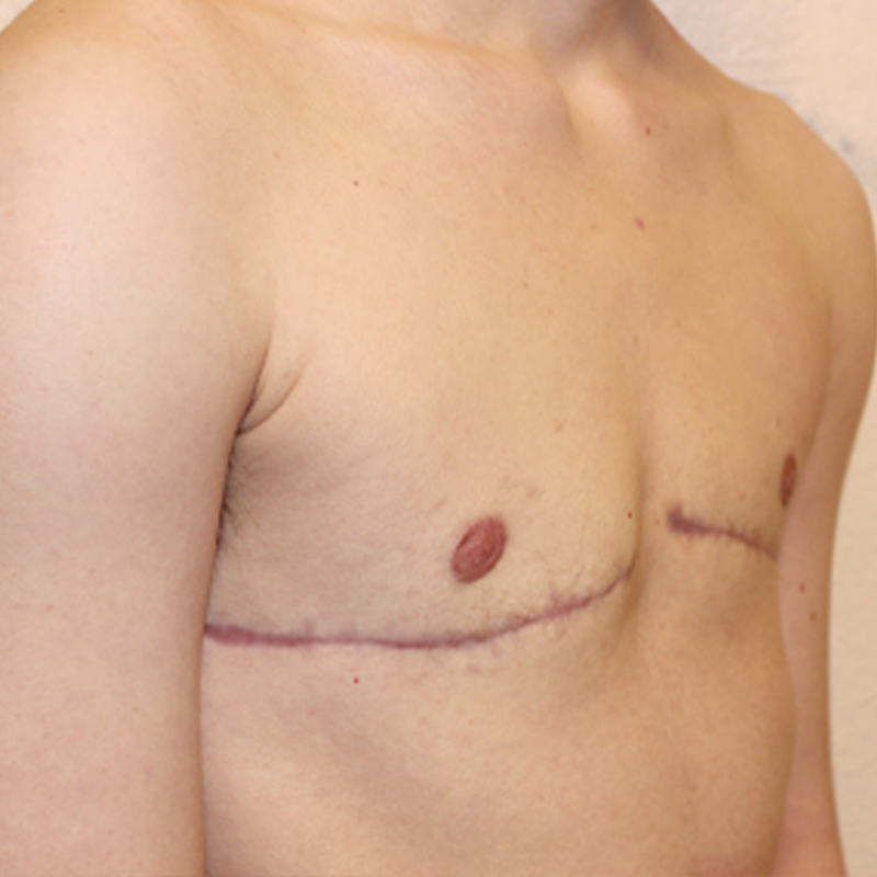 Female To Male Top Surgery 07