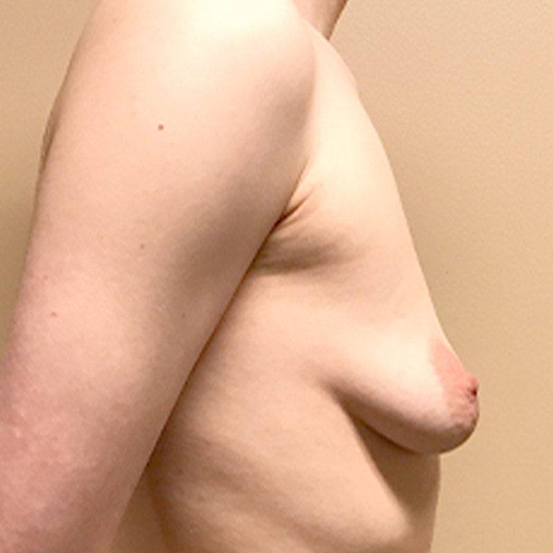 Female To Male Top Surgery 09