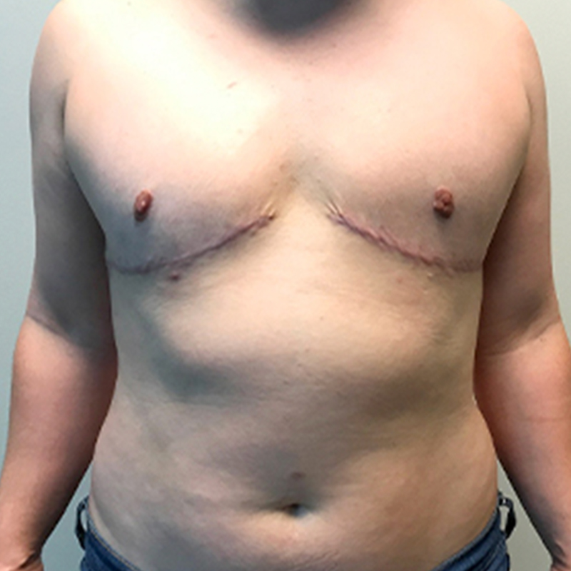 Female To Male Top Surgery 94