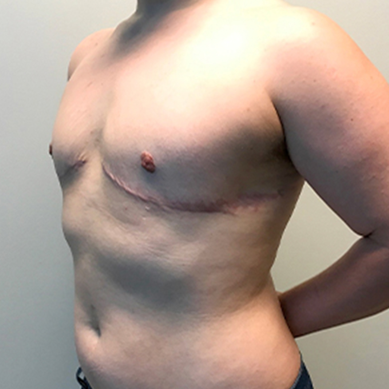 Female To Male Top Surgery 03