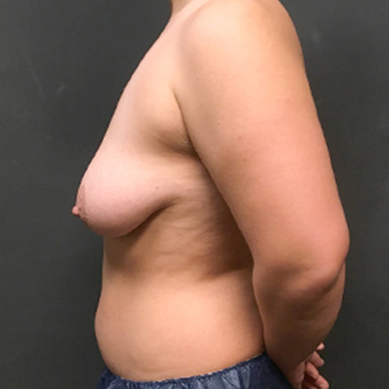 Female To Male Top Surgery 05