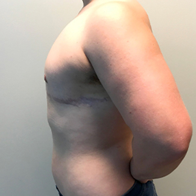 Female To Male Top Surgery 05