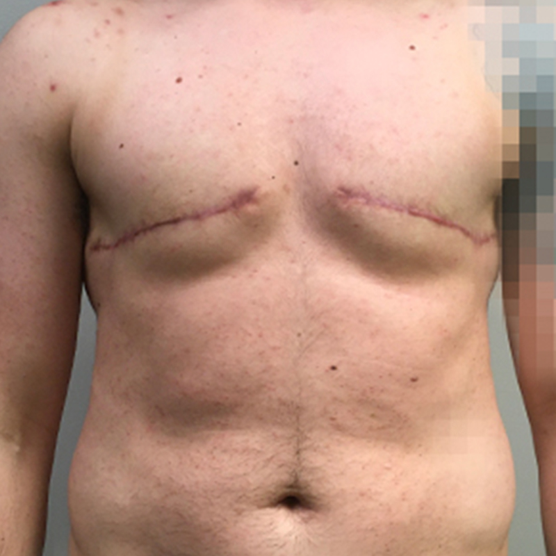 Female To Male Top Surgery 01