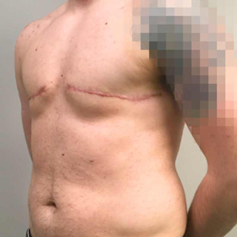 Female To Male Top Surgery 03