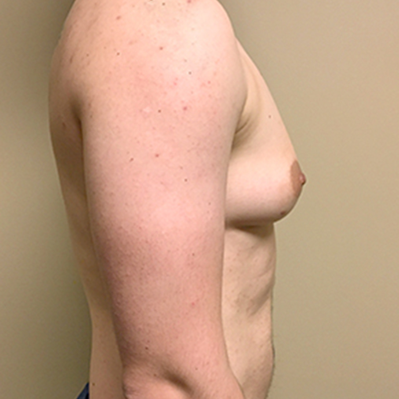 Female To Male Top Surgery 09