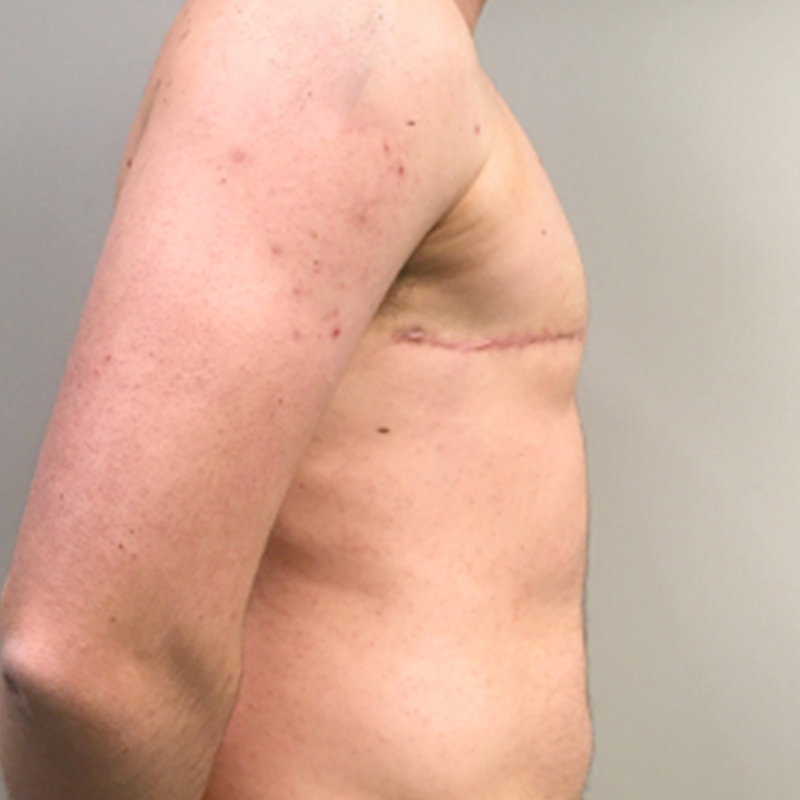 Female To Male Top Surgery 09