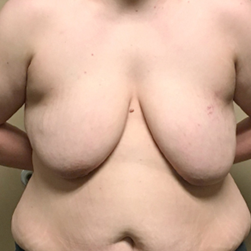 Female To Male Top Surgery 01