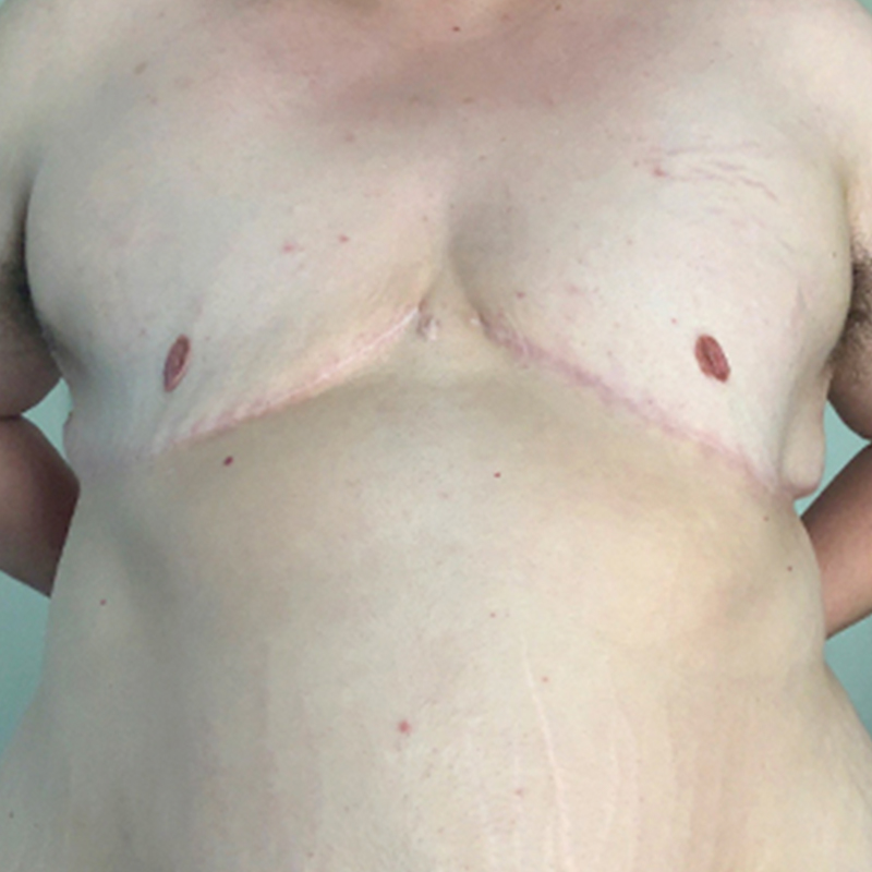 Female To Male Top Surgery 96