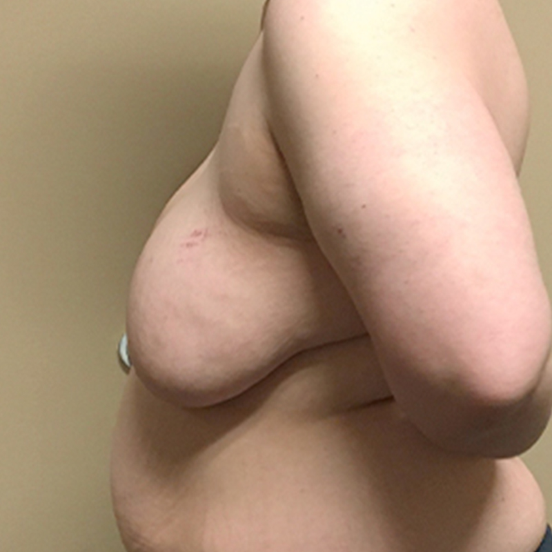 Female To Male Top Surgery 05