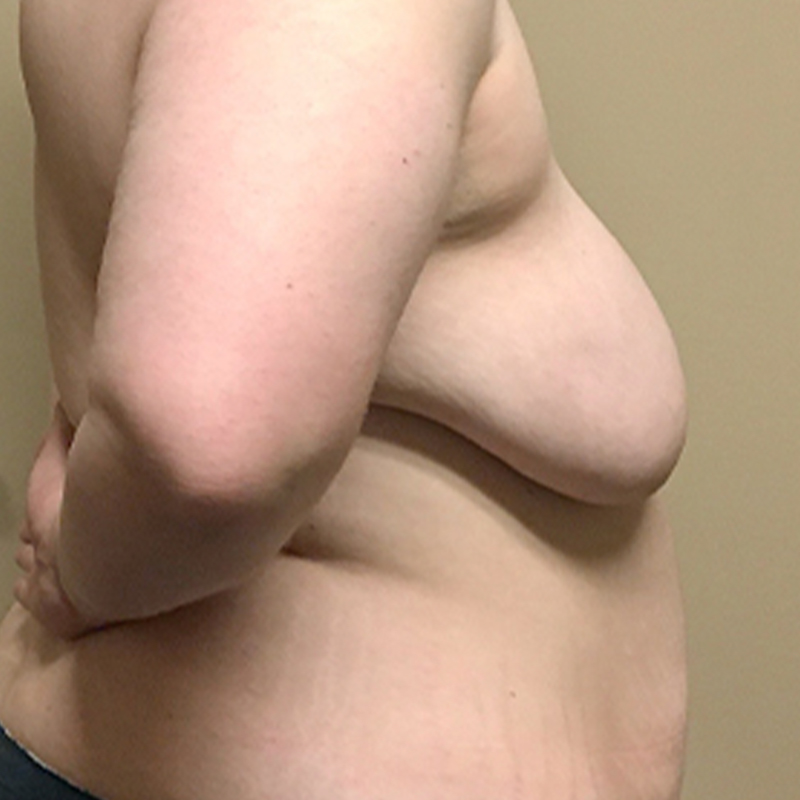 Female To Male Top Surgery 09