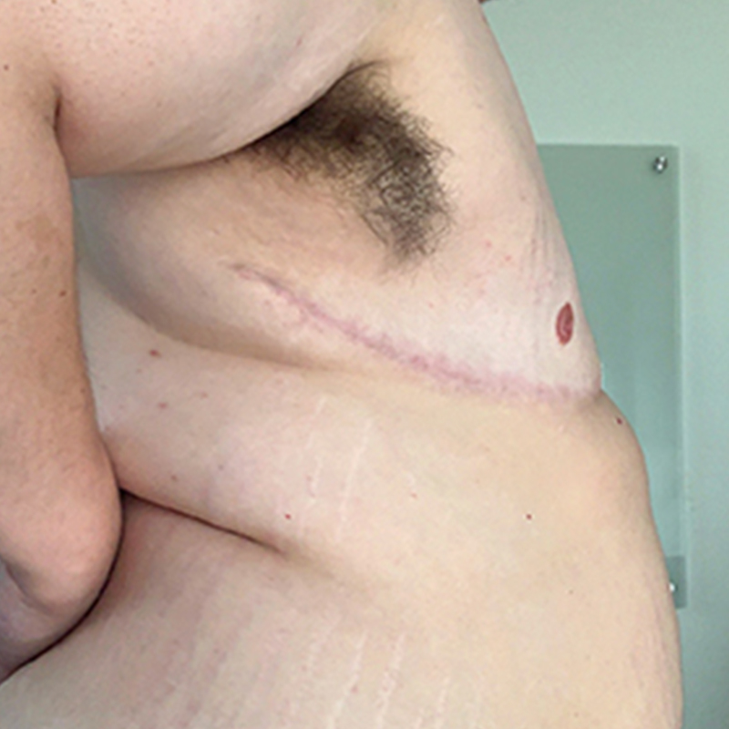 Female To Male Top Surgery 09