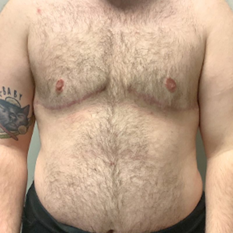 Female To Male Top Surgery 97