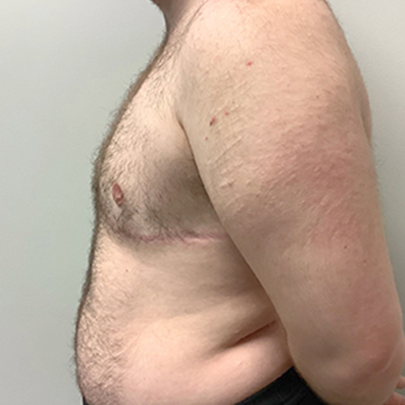 Female To Male Top Surgery 05