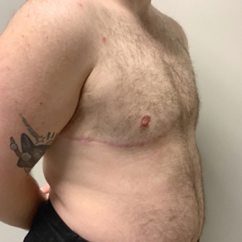 Female To Male Top Surgery 09