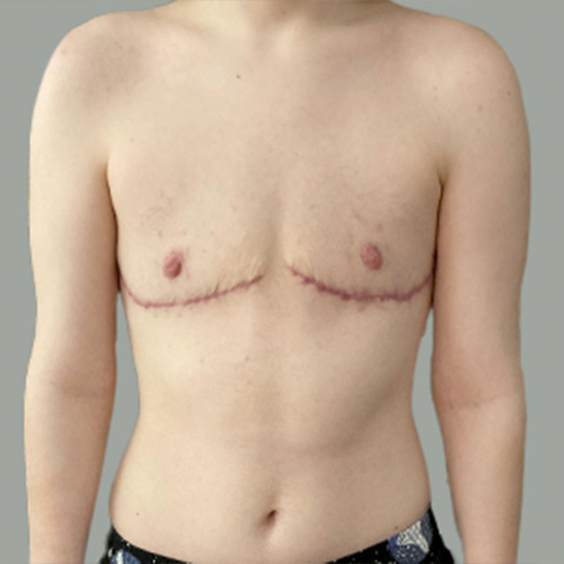 Female To Male Top Surgery 98