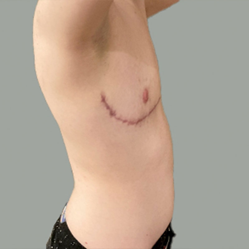 Female To Male Top Surgery 09