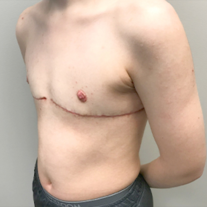 Female To Male Top Surgery 03