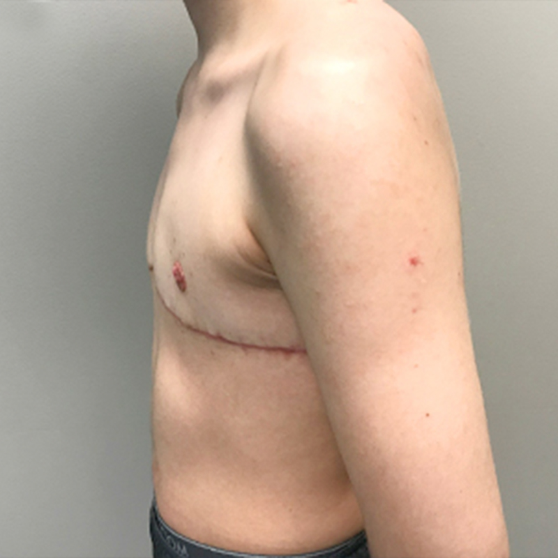 Female To Male Top Surgery 05