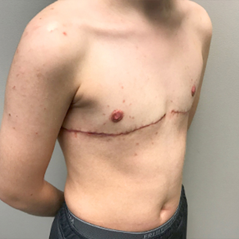 Female To Male Top Surgery 07