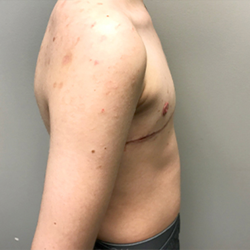 Female To Male Top Surgery 09