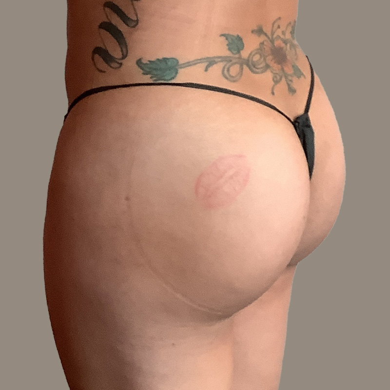 Ftm Body Contouring 03