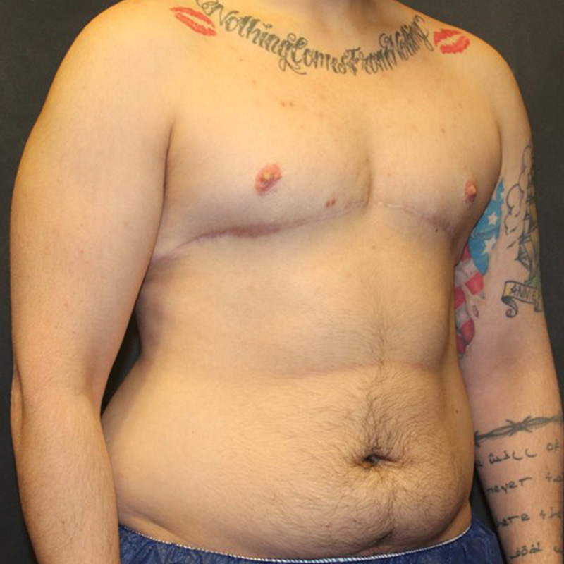 Ftm Body Contouring 03