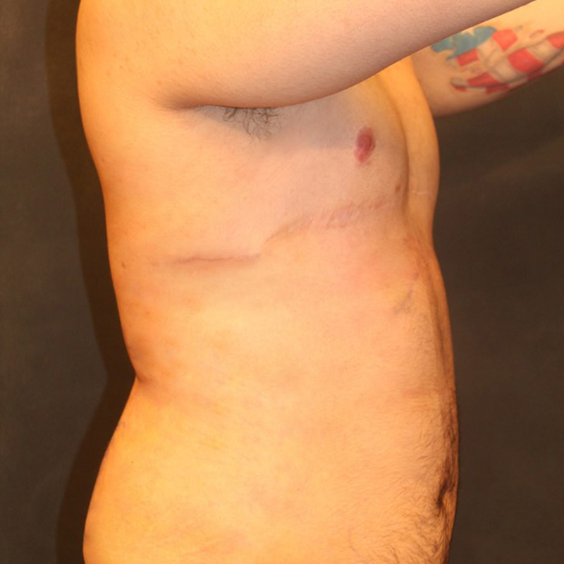 Ftm Body Contouring 03