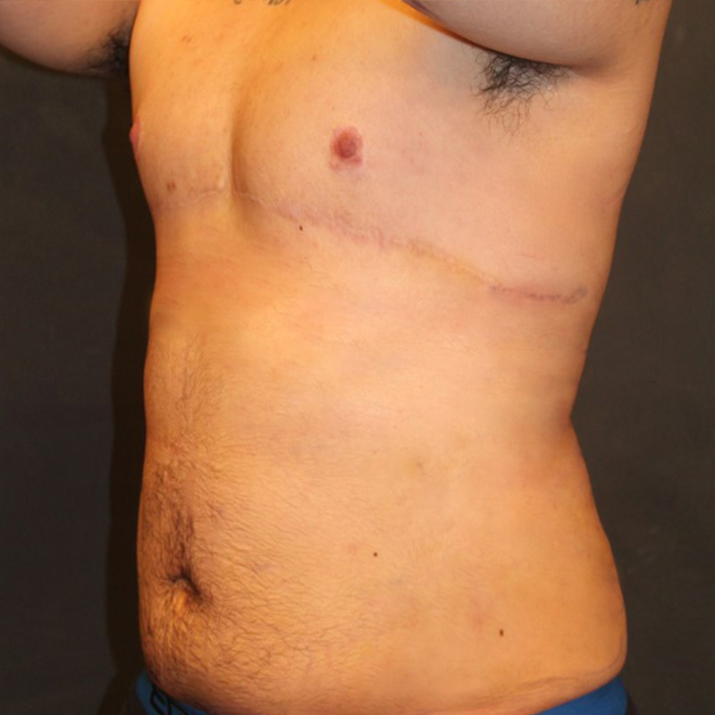 Ftm Body Contouring 05