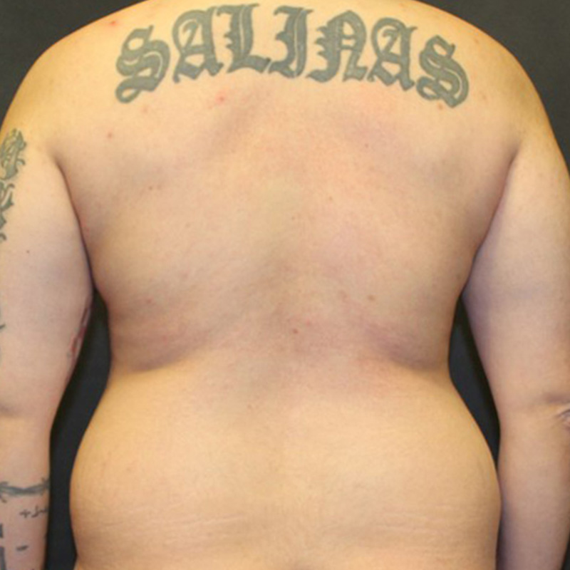 Ftm Body Contouring 09