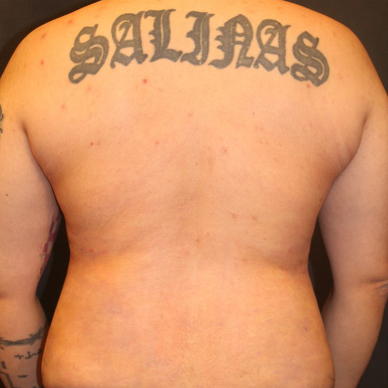 Ftm Body Contouring 09