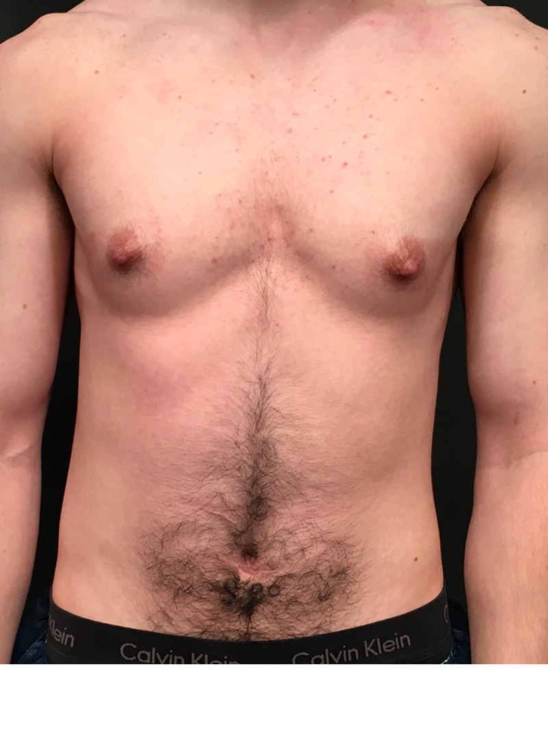 Ftm Body Contouring 01