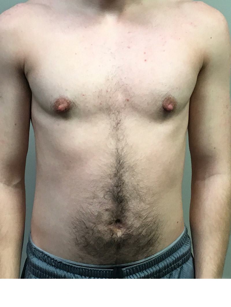 Ftm Body Contouring 03