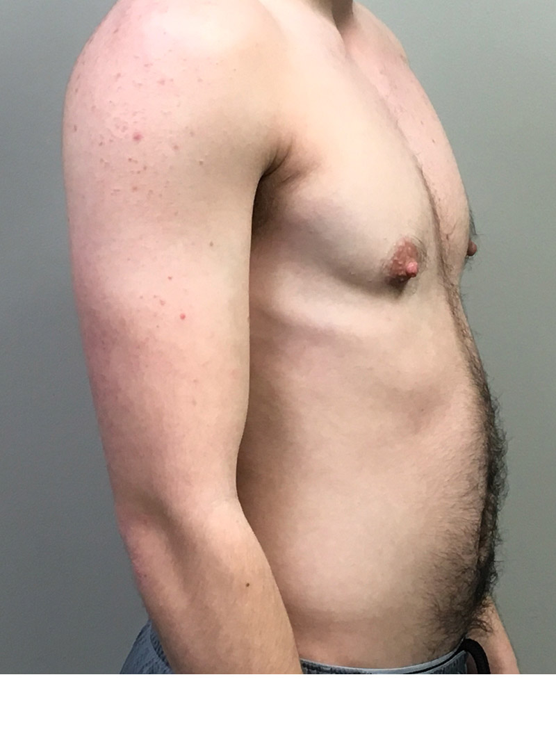 Ftm Body Contouring 03