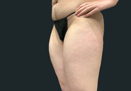 Ftm Body Contouring 01