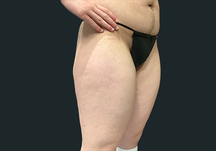 Ftm Body Contouring 03