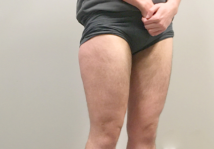 Ftm Body Contouring 03