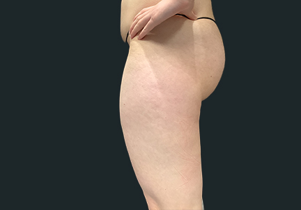 Ftm Body Contouring 05