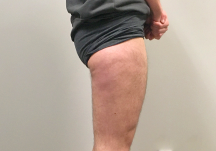 Ftm Body Contouring 07