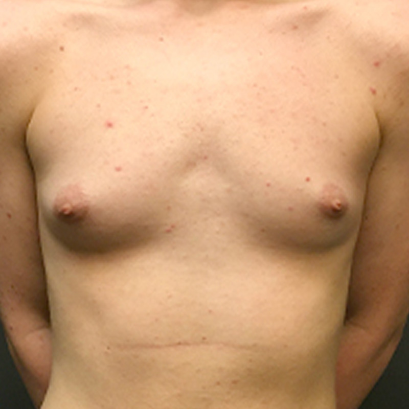 Ftm Keyhole Chest Reconstruction 01