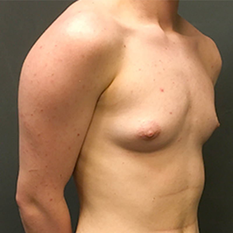 Ftm Keyhole Chest Reconstruction 03