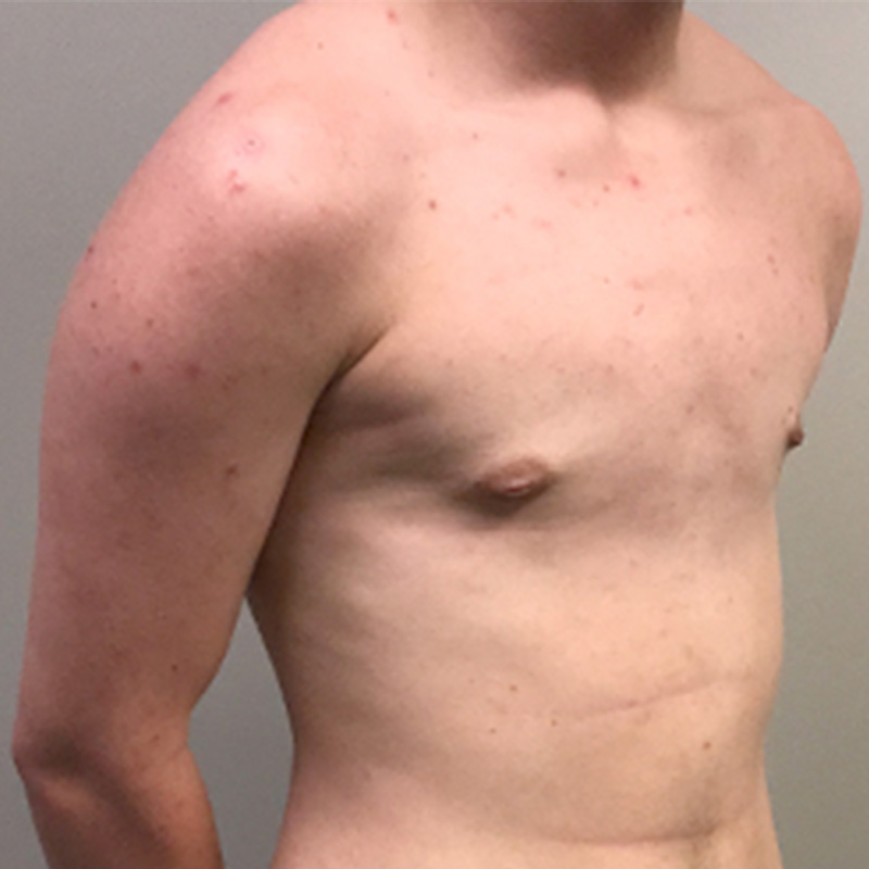 Ftm Keyhole Chest Reconstruction 03