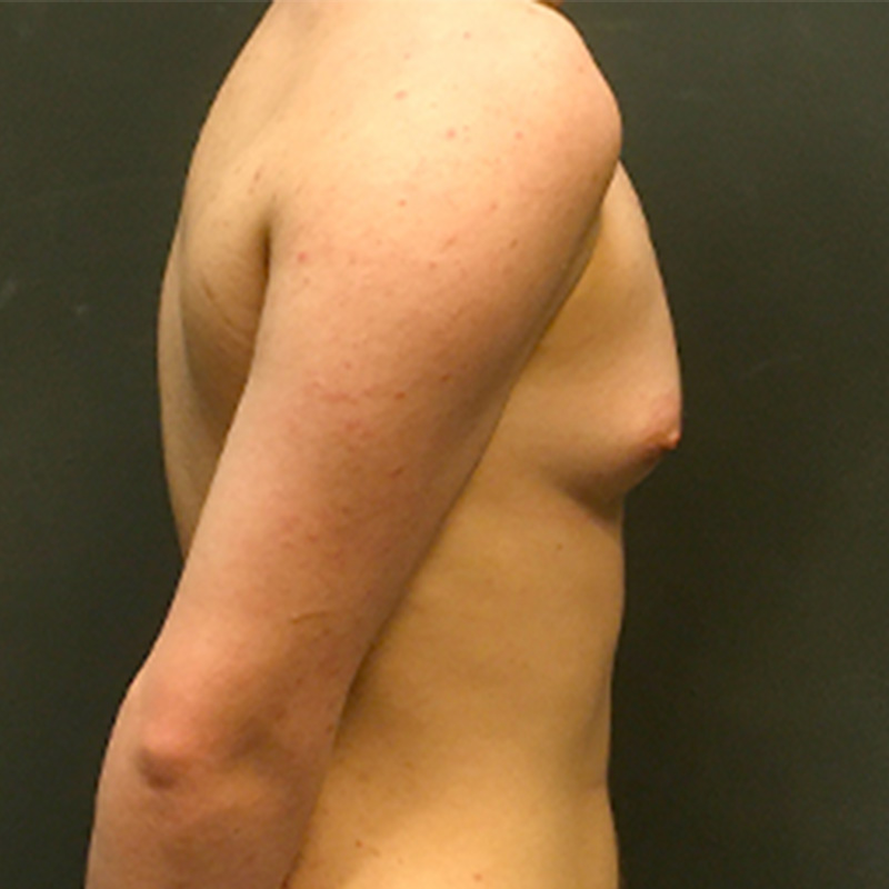 Ftm Keyhole Chest Reconstruction 05