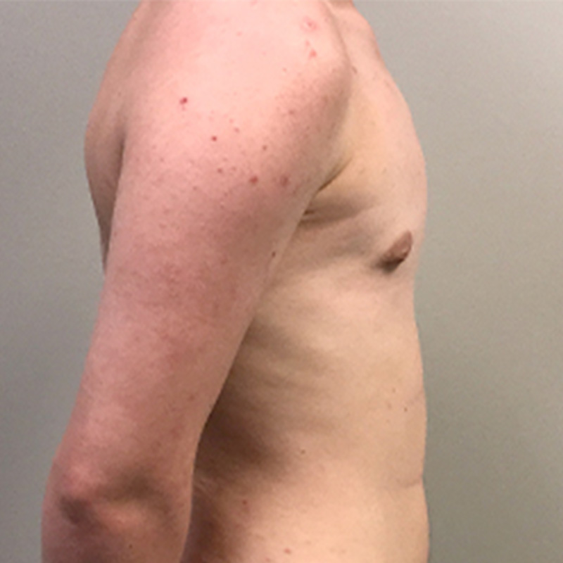 Ftm Keyhole Chest Reconstruction 05