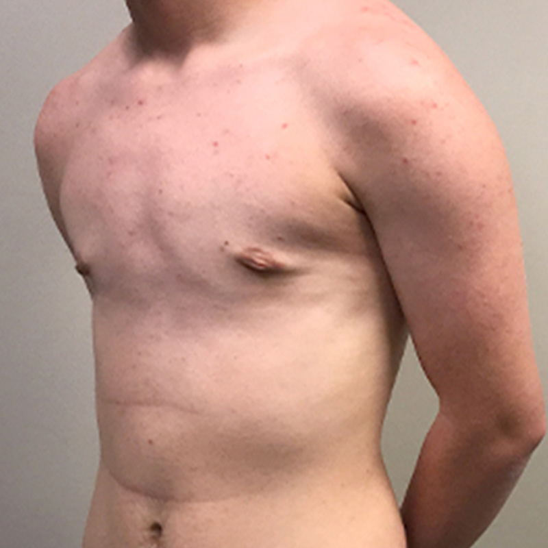 Ftm Keyhole Chest Reconstruction 07