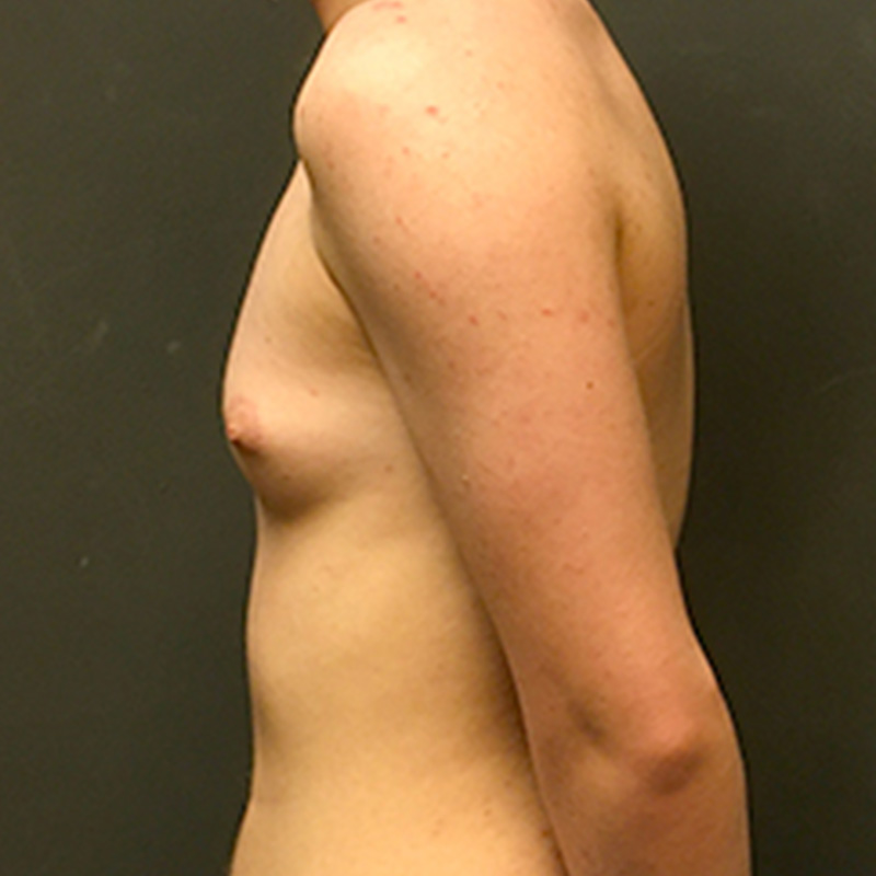 Ftm Keyhole Chest Reconstruction 09