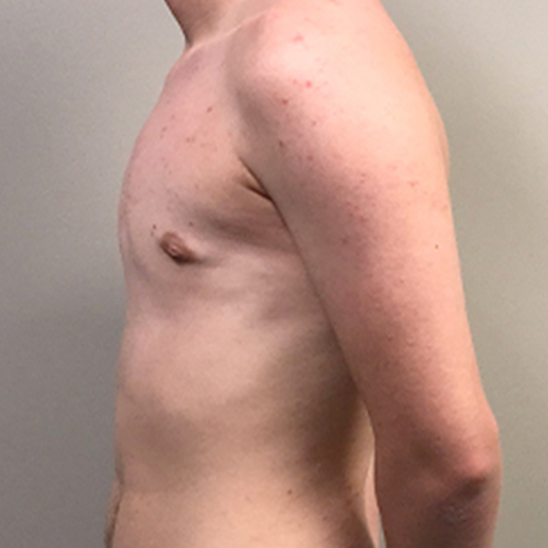 Ftm Keyhole Chest Reconstruction 09