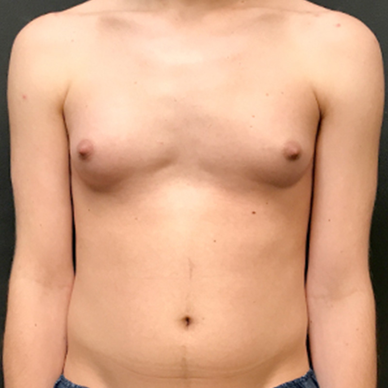 Ftm Keyhole Chest Reconstruction 01