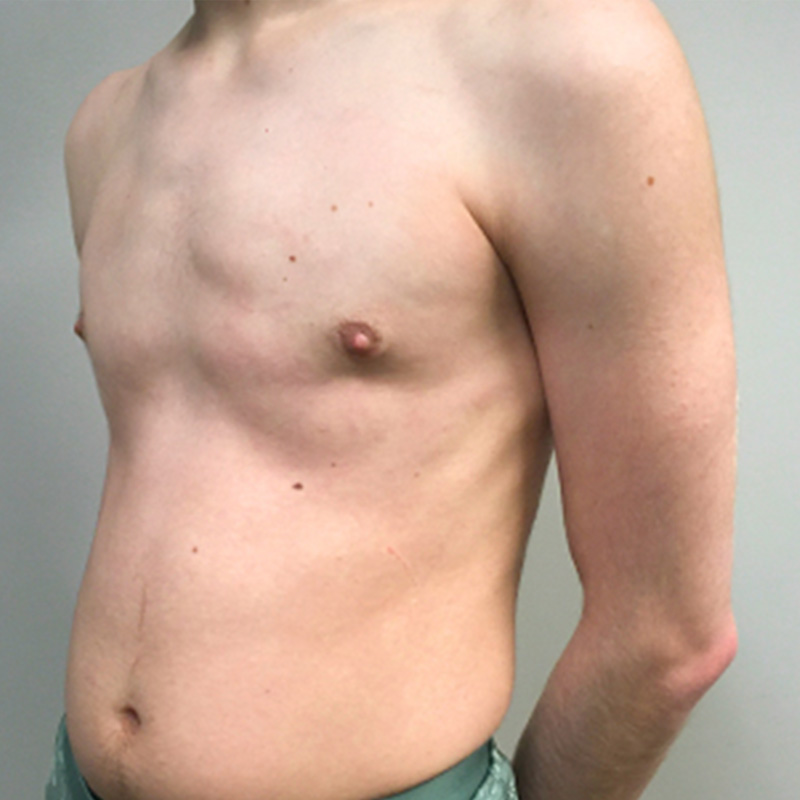 Ftm Keyhole Chest Reconstruction 03